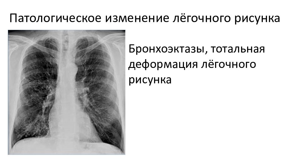 Рисунок легких усилен и деформирован что это значит