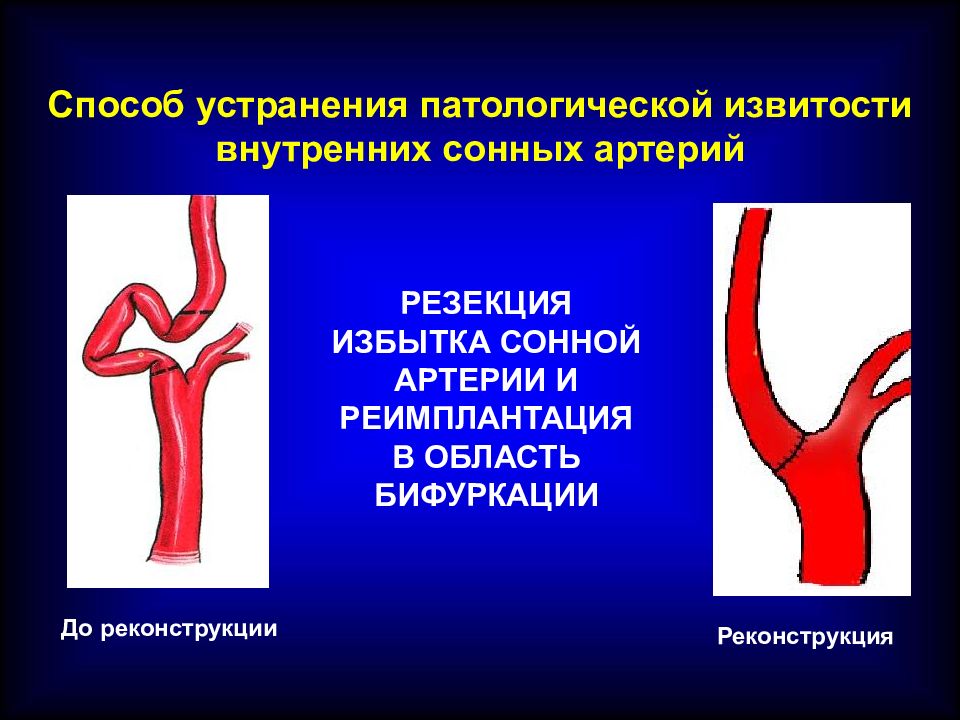 Внутренняя сонная артерия картинки