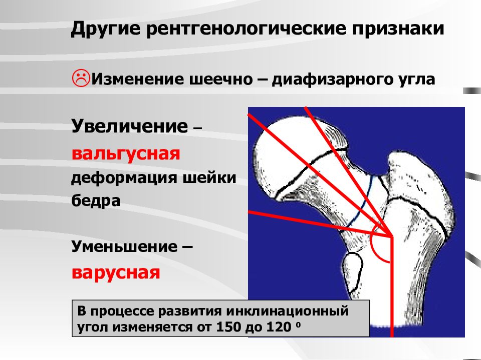 Сустав норма. Варусная деформация бедренной кости. Варусная деформация шейки бедренной кости. Угол Виберга тазобедренного сустава. Шеечно-диафизарный угол бедренной кости у взрослых.