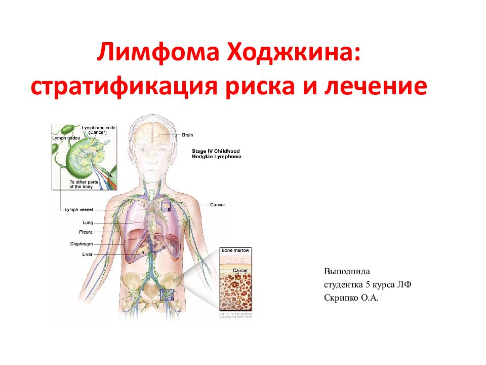 Лимфома ходжкина презентация