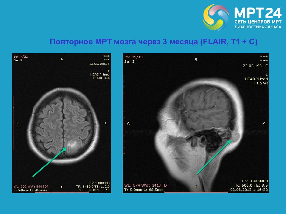 Боюсь мрт мозга