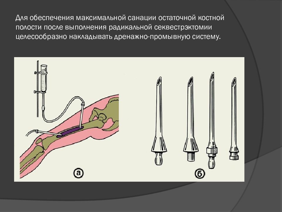 Секвестрэктомия при остеомиелите. Секвестрэктомия легкого. Пластика остаточной костной полости. Секвестрэктомия предоперационная подготовка.