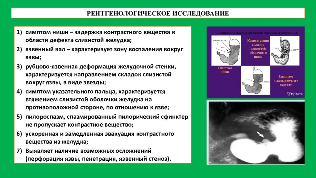 Симптом д. Симптомы ниши язвенной болезни желудка. Рентгенологическое исследование при язве желудка. Рентгенологические признаки язвенной болезни желудка. Рентгенологический симптом ниши.