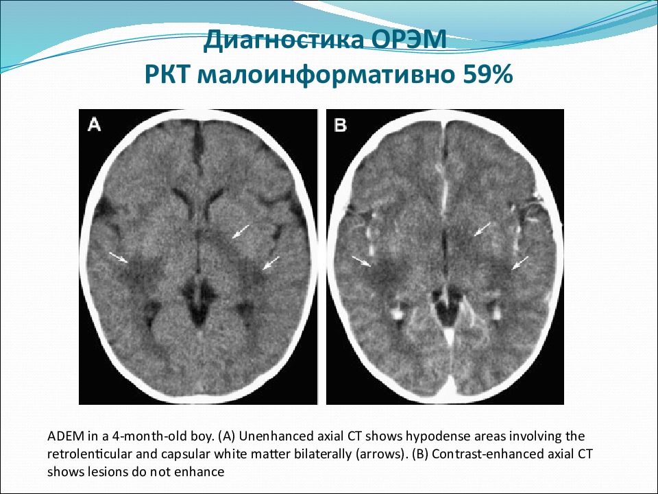 Острый рассеянный энцефаломиелит презентация