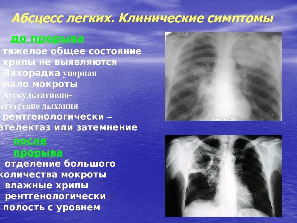 Абсцесс легкого операция. Симптомы при абсцессе легкого. Клиническая картина абсцесса легкого.