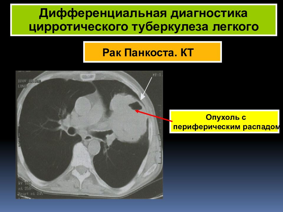 Рак с распадом