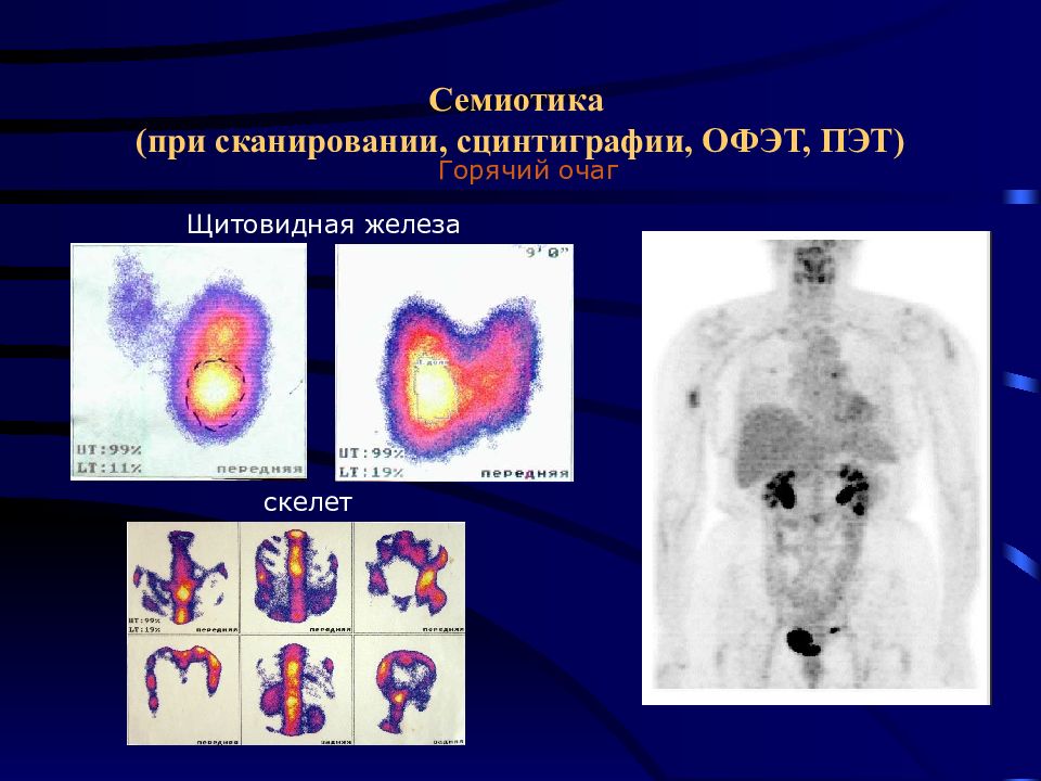 Сцинтиграфия щитовидной железы это