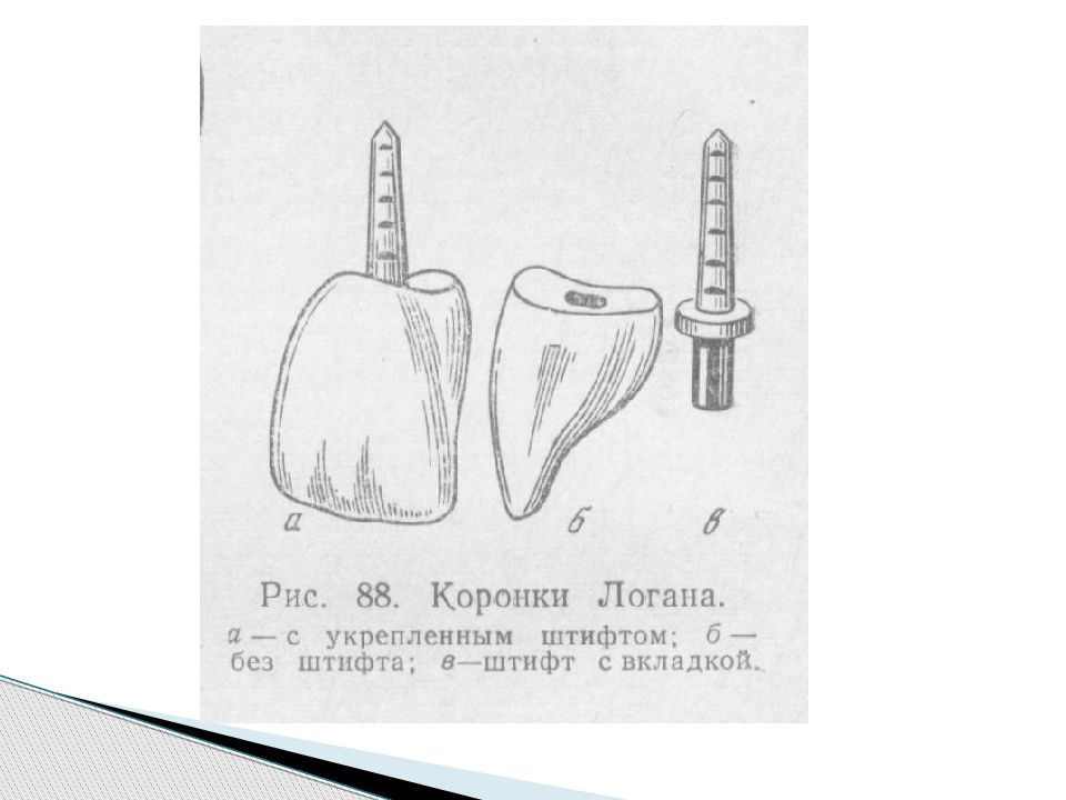 Штифтовый зуб по ричмонду. Коронка Ричмонда штифт. Коронка Логана (штифтовой зуб). Установка коронки на штифт схема. Штифтовые зубы и штифтовые конструкции.