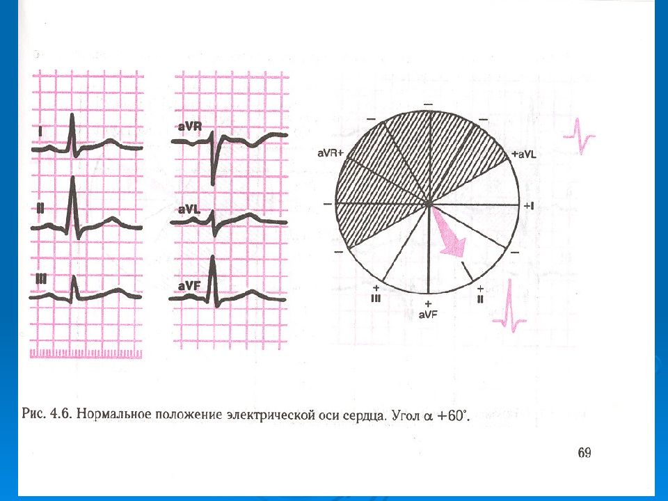 S Тип электрической оси сердца. Нормальная электрическая ось сердца. Ось сердца на ЭКГ. Ось сердца AVL.
