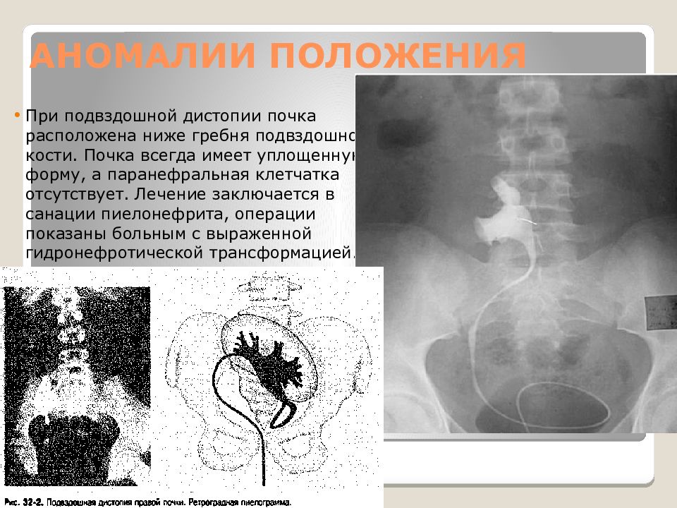 Дистопия почки. Подвздошная дистопия почки. Почка на уровне гребня подвздошной кости. Дистопия почки классификация. Дистопия почки порок развития.