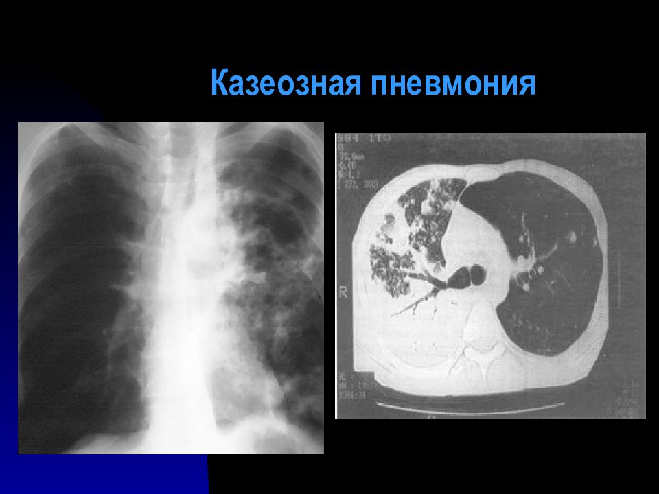 Казеозная пневмония фтизиатрия презентация