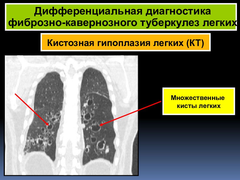 Укажите характер стенки каверны при фиброзно кавернозном туберкулезе