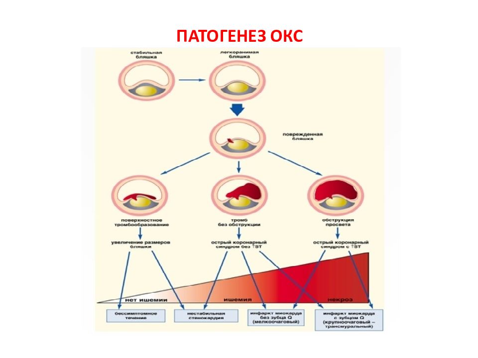 Клиническая картина окс