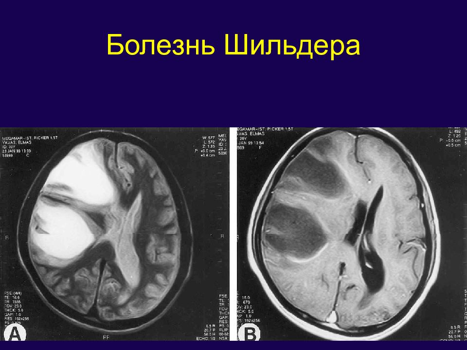 Заболевания цнс презентация