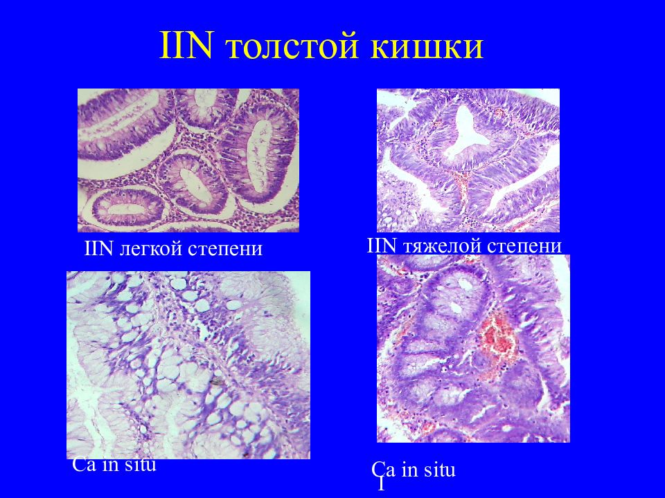 Тубулярно ворсинчатая аденома с интраэпителиальной неоплазией. Аденома кишечника гистология. Тубуло-ворсинчатая аденома толстой кишки гистология. Ворсинчатая аденома гистология. Виллезная аденома толстой кишки гистология.