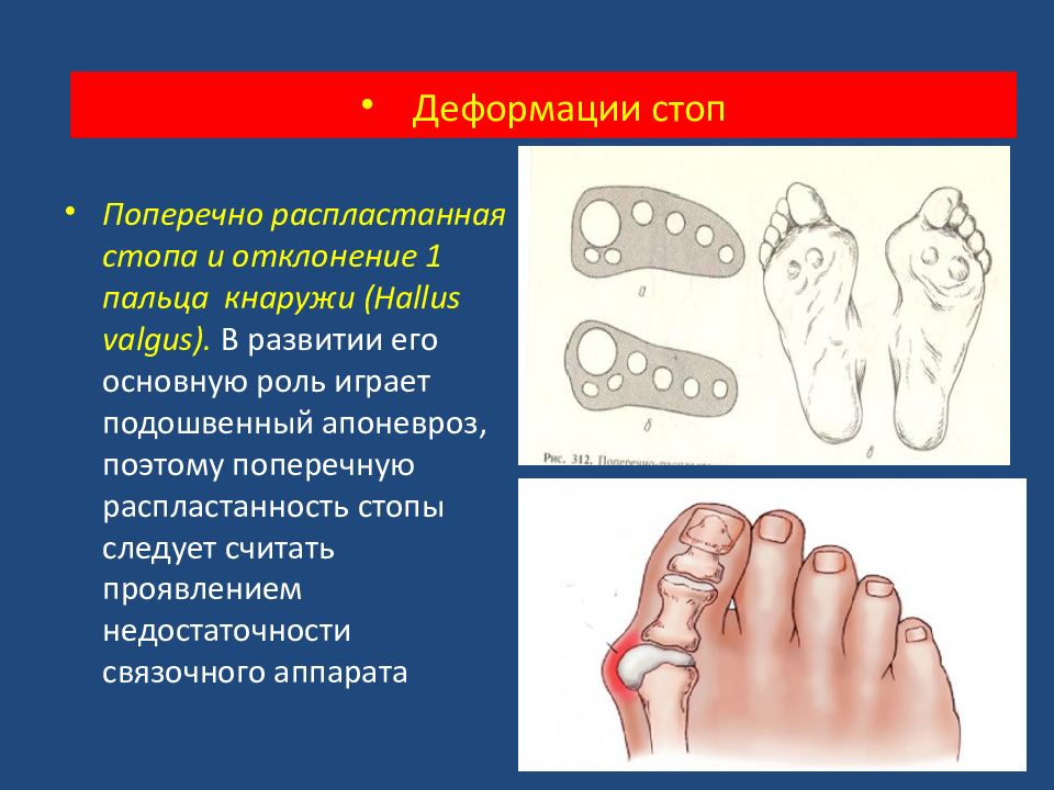 Деформация пальцев стопы. Стадии деформации стопы. Деформация переднего отдела стопы. Поперечно-распластанная стопа и отклонение 1 пальца стопы кнаружи. Профилактика деформации стоп.