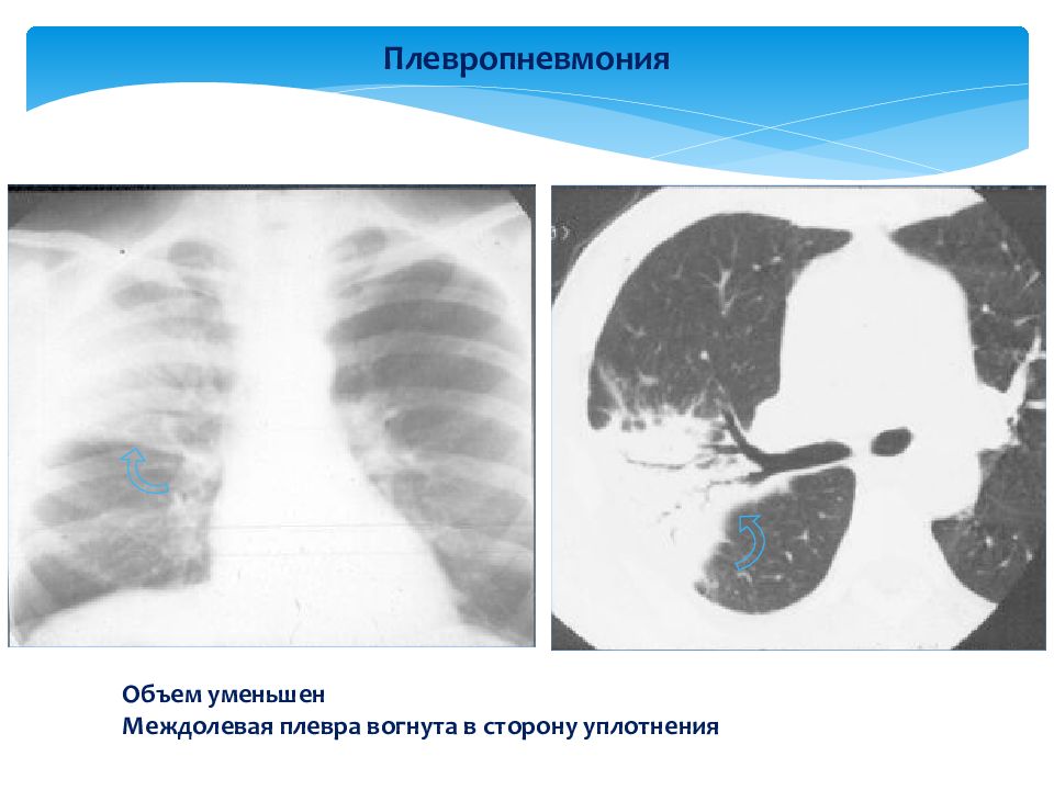 Плевропневмония. Симптомы плевропневмонии рентген. Плевропневмония и плеврит. Плевропневмония левого легкого.
