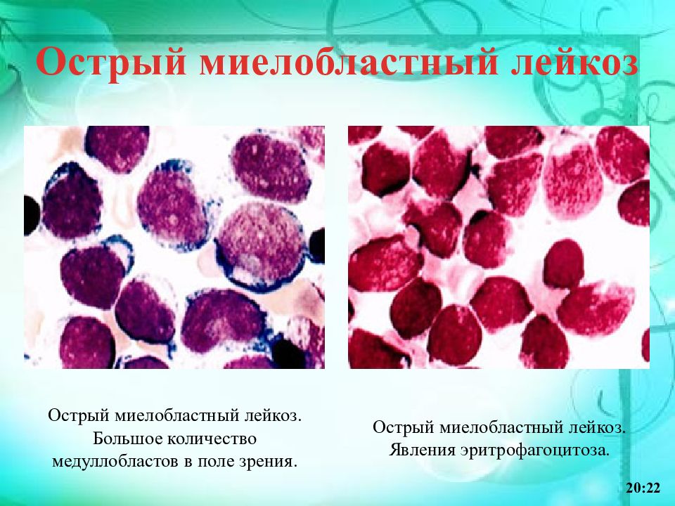 Острый миелобластный лейкоз презентация