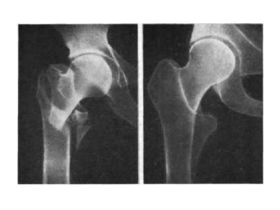 Повреждение бедренной кости. Родовая травма перелом бедренной кости. Перелом бедренной кости у новорожденного. Перелом бедра родовая травма рентген. Родовая травма плечевой кости.
