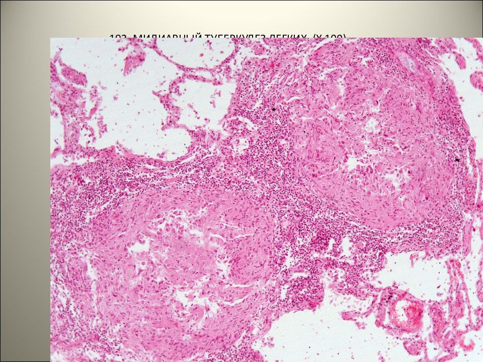 Казеозный некроз гистология. Фиброзно кавернозный туберкулез гистология. Гистологическое исследование при туберкулезе. Клетки пирогова лангханса гистология. Цирротический туберкулез гистология.