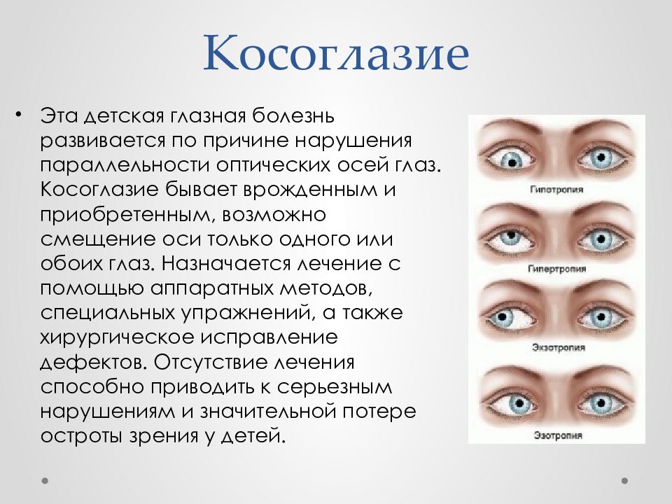 Косит глаз причины. Косоглазие у детей. Косоглазие глаза. Причины заболевания косоглазие. Косоглазие зрение.