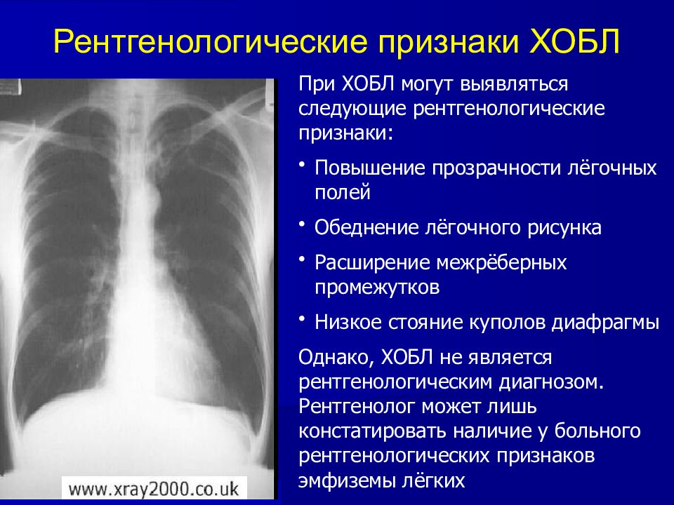 Рентген картина бронхита что это