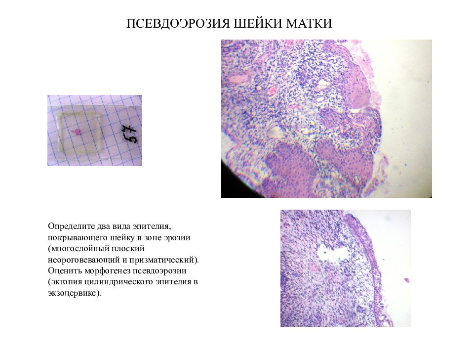 Экзоцервикс. Морфогенез хронического венозного полнокровия. Эпителий экзоцервикса. Морфогенез изменений в легких при хроническом венозном полнокровии. Хроническое венозное полнокровие печени микропрепарат.