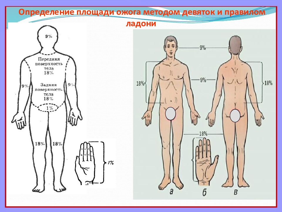 Оценка площади ожога проводится по схеме