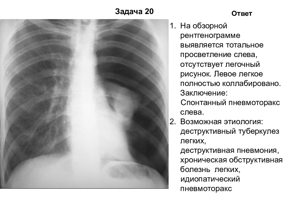 Рентген картина пневмоторакса