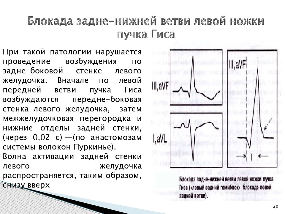 Блокада левой ножки пучка гиса. Блокада ветвей левой ножки пучка Гиса на ЭКГ. Неполная блокада левой ветви пучка. Проводимости блокады пучка Гиса. Неполная блокада левой ножки на ЭКГ.