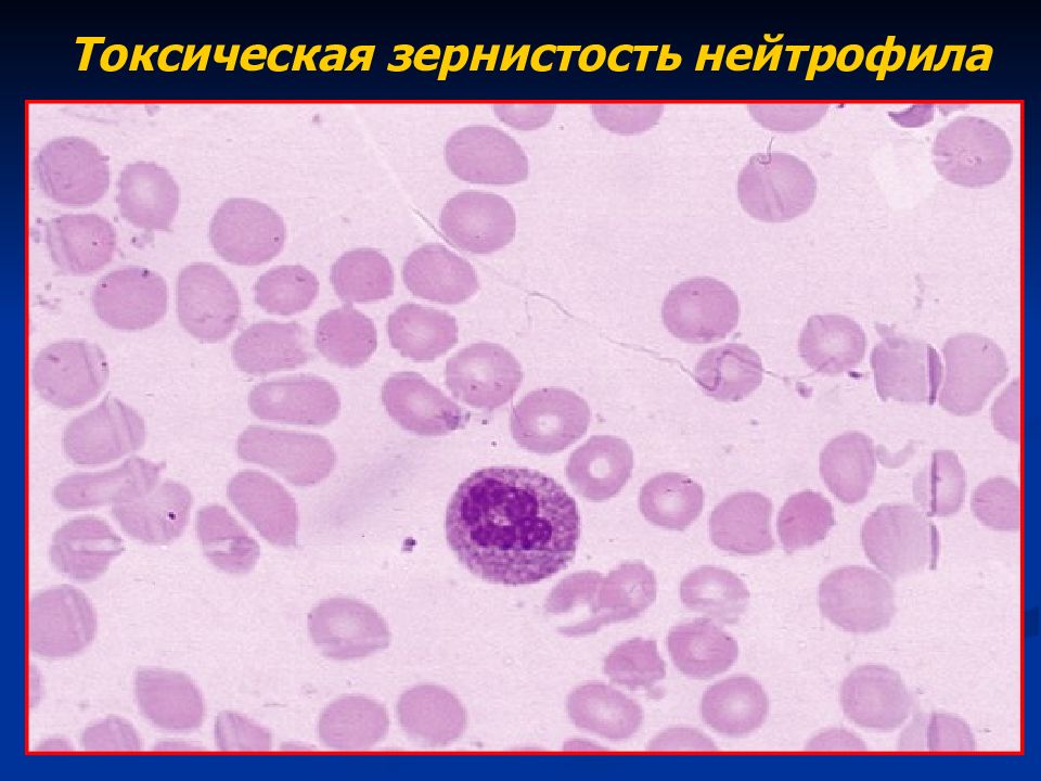 Токсогенная зернистость нейтрофилов. Базофильная зернистость нейтрофилов. Токсическая зернистость нейтрофилов лейкоз. Токсическая зернистость нейтрофилов вакуолизация.