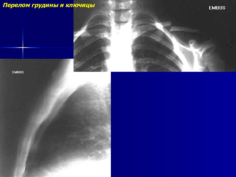 Перелом грудины. Рентгенодиагностика повреждений груди. Травма грудной клетки рентгенодиагностика.