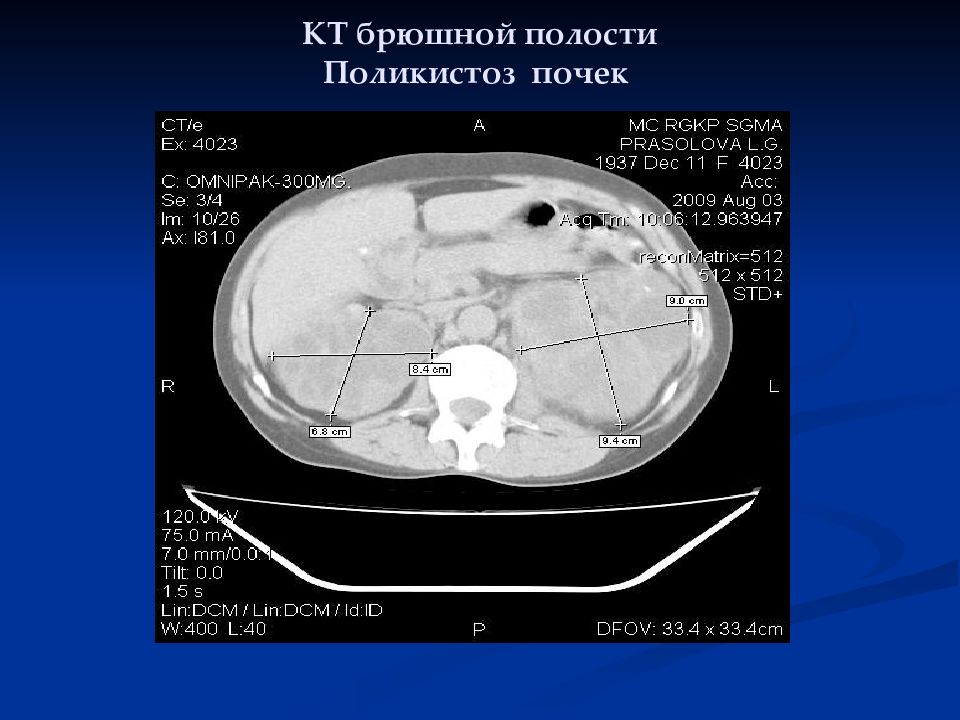 Размеры почек. Размеры почек на кт. Сегменты почек на кт. Кт почек норма. Измерение почек на кт.