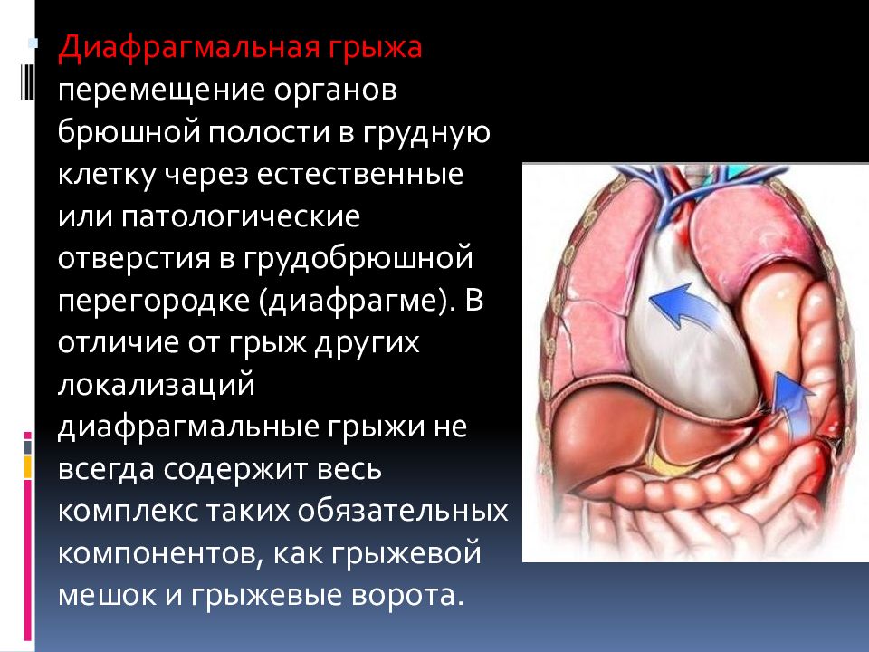 Врожденная диафрагмальная грыжа презентация