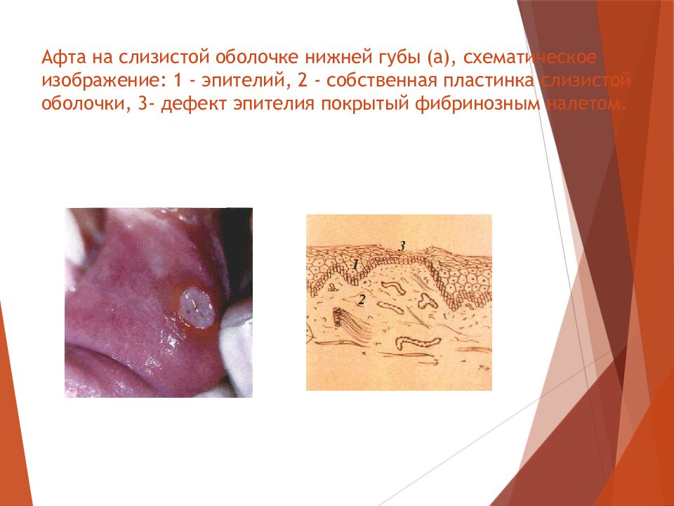 Афта на слизистой оболочке нижней губы (а), схематическое изображение: 1 - эпителий, 2 - собственная пластинка слизистой оболочки, 3- дефект эпителия покрытый