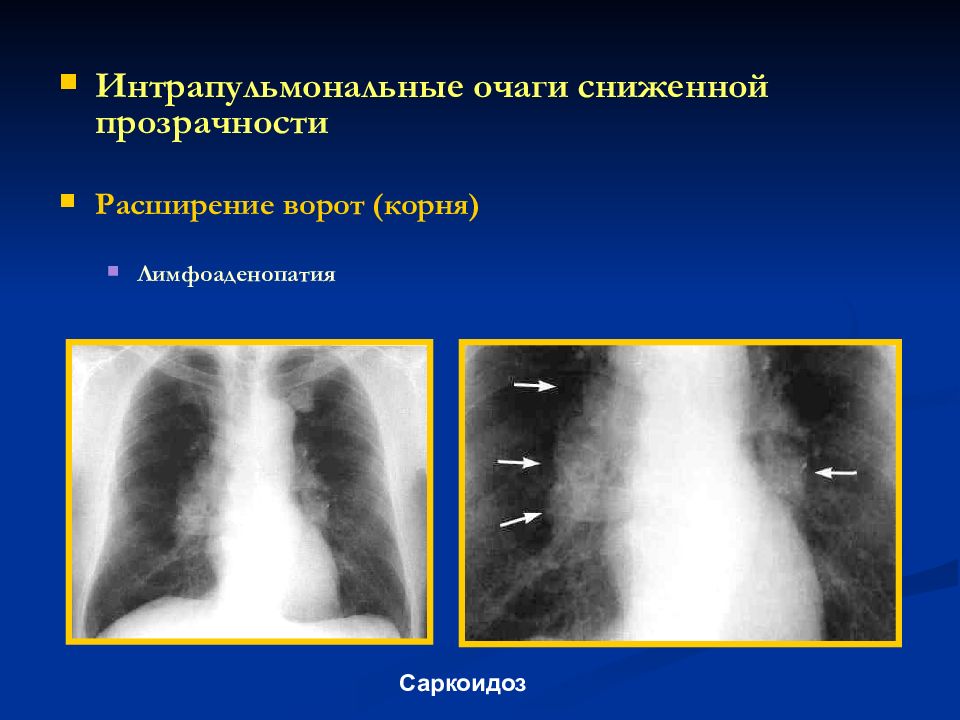 Лимфаденопатия средостения легких что это такое