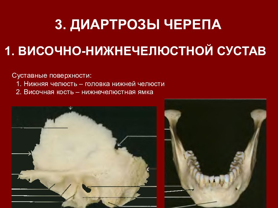 Соединение нижнечелюстной и височной кости. Анатомия сустава ВНЧС. Кости черепа височно-нижнечелюстной сустав. Нижнечелюстной сустав головка нижней челюсти. Череп анатомия нижнечелюстной сустав.