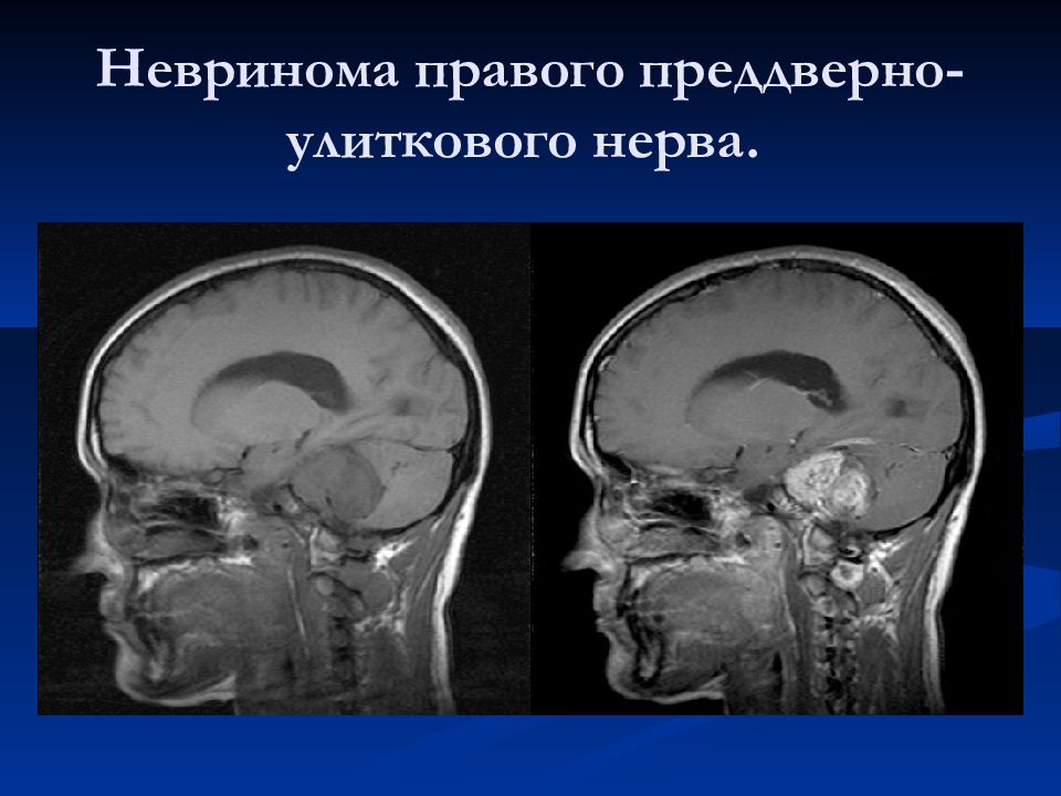 Невринома. Невринома преддверно-улиткового нерва мрт. Субдуральная невринома. Невринома слухового нерва макропрепарат. Невринома периферических нервов.