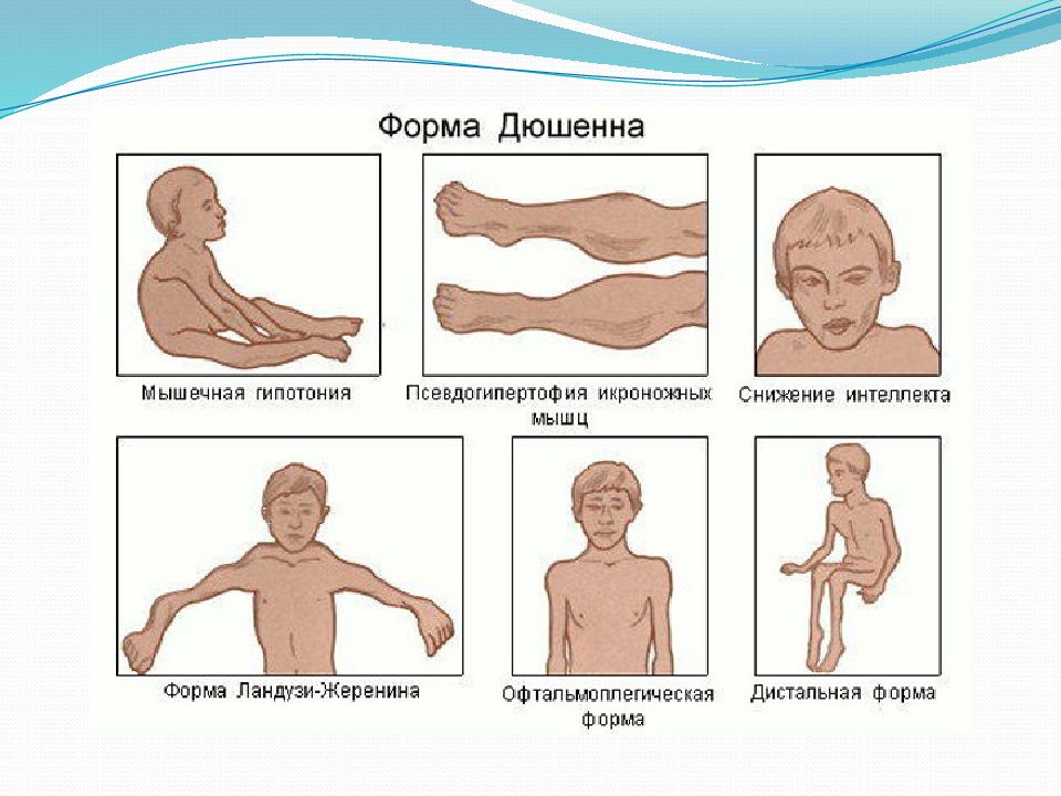 Мышечная дистрофия дюшенна картинки