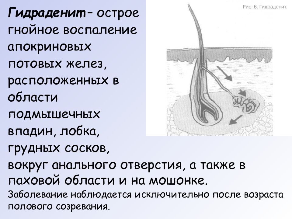 Заболевание желез воспаление. Воспаление потовой железы. Гнойное воспаление апокриновых потовых желез. Гидраденит- воспаление потовых желез.