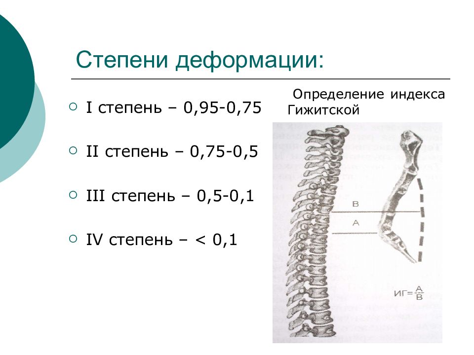 Стадии искривления