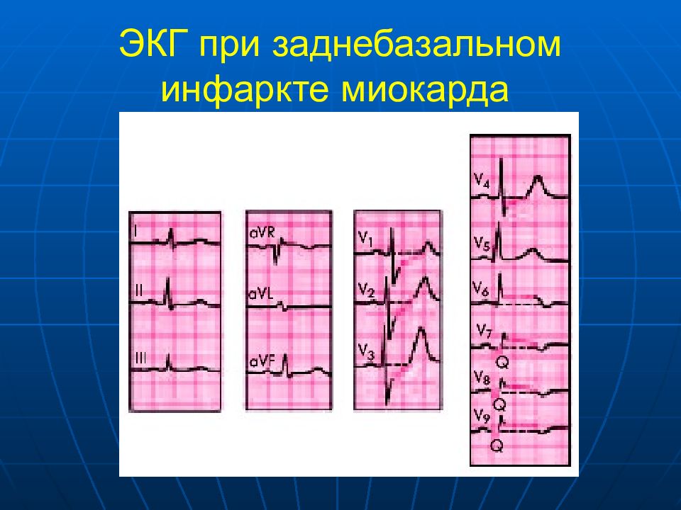 признаки заднебазального инфаркта. экг при заднебоковом инфаркте. заднебазальный инфаркт миокарда экг. экг при нижнедиафрагмальном инфаркте. экг при задне базальном инфакркте миокарда.
