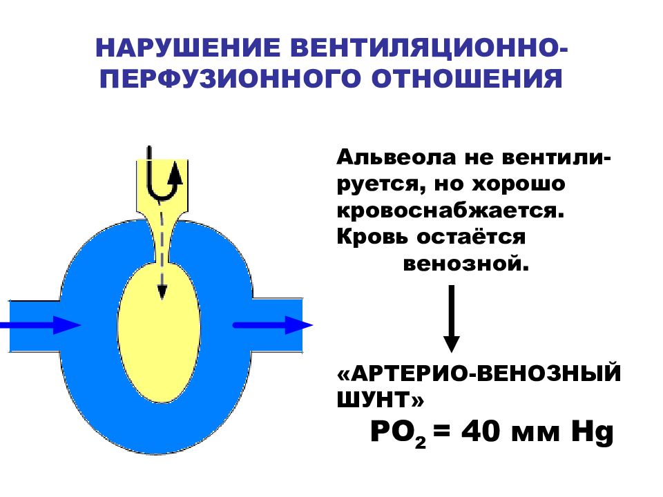 Перфузионно вентиляционное соотношение. Нарушение вентиляционно-перфузионных отношений. Вентиляционно перфузионное соотношение. Вентиляционно-перфузионного отношения. Коэффициент вентиляционно перфузионных отношений.