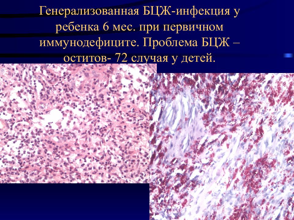 Генерализованная бцж инфекция презентация