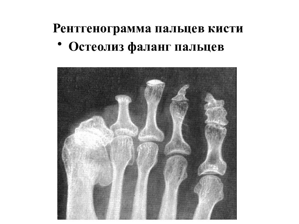 Остеолиз это. Остеолиз концевых фаланг. Остеолиз костей рентген. Остеолиз на рентгене костей стопы.