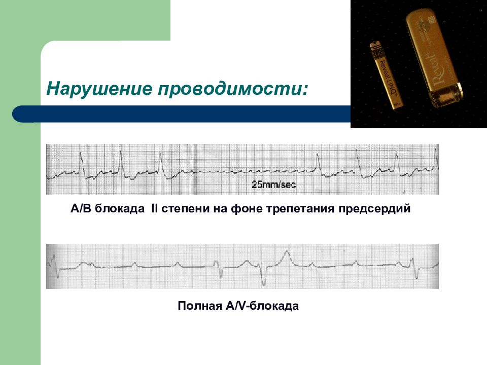 Нарушения проводимости презентация