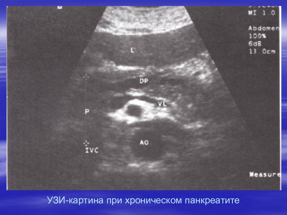 Узи картина. УЗИ картина хронического панкреатита. Трансабдоминальное УЗИ при хроническом панкреатите. Хронический кальцифицирующий панкреатит УЗИ. Острый панкреатит УЗИ картина.