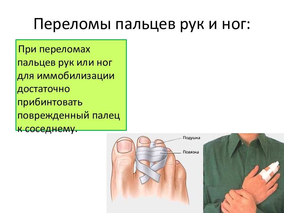 Как сломать палец. Иммобилизация при переломе пальцев. Переломы пальцев рук и ног. Первая помощь при переломе пальца руки. Иммобилизация при переломе пальца ноги.