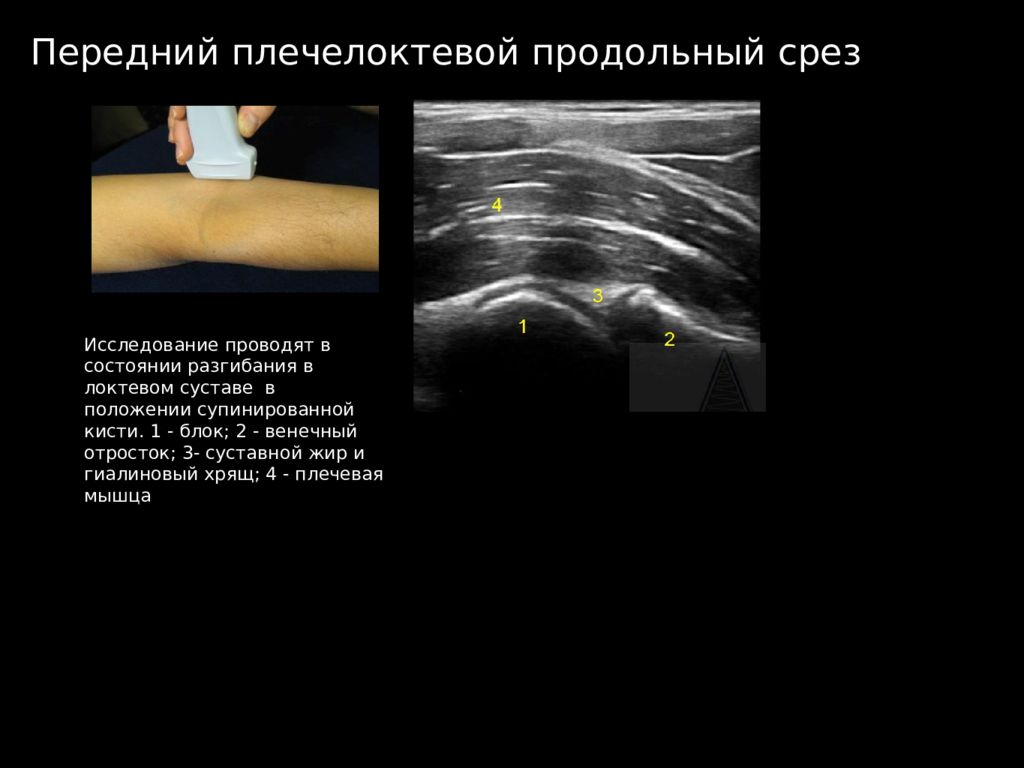 Узи сочленения. Локтевой сустав УЗИ Диагностер. Бурсит локтевого сустава на УЗИ протокол. УЗИ мягких тканей локтевого сустава протокол. Эпикондилит локтевого сустава на УЗИ протокол.