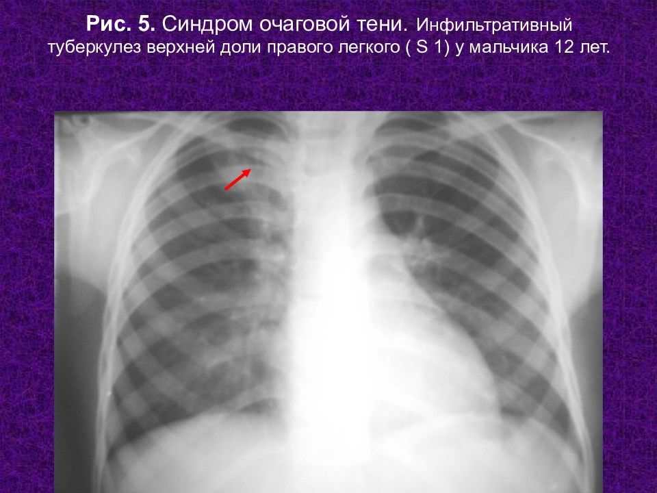 Верхние доли легких тени. Синдром очаговой тени в легком. Рентген инфильтративный туберкулез верхней доли левого легкого. Очагово-инфильтративный туберкулез рентген. Инфильтративный туберкулез рентгенологический синдром.